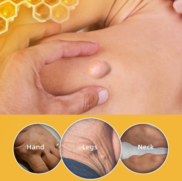 Sumifun Bee Venom Lipoma Removal Cream - Image 3