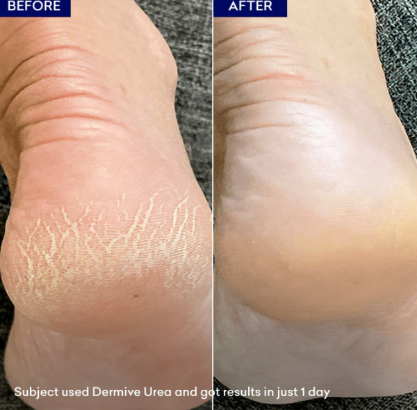 Dermive Urea Cream 100ML - Image 4